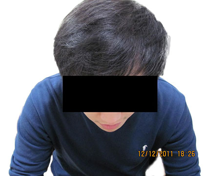 Cheveux homme après implantation capillaire