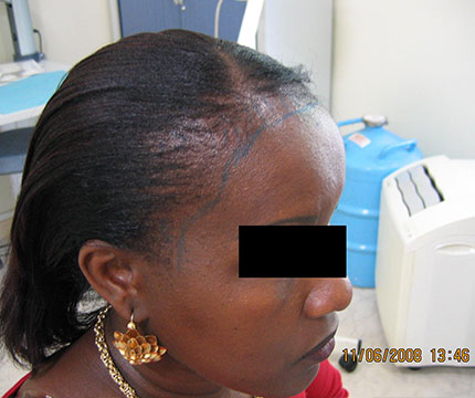 Cheveux de femme avant l'implantation capillaire