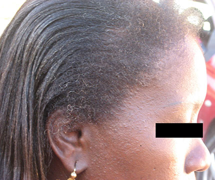 Cheveux de femme après l'implantation capillaire