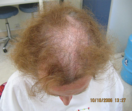 Cheveux femme avant l'implantation de cheveux
