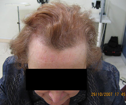 Cheveux d'une femme avant l'implantation capillaire