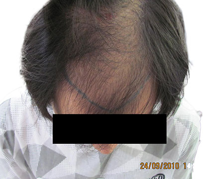 Cheveux homme avant implantation capillaire