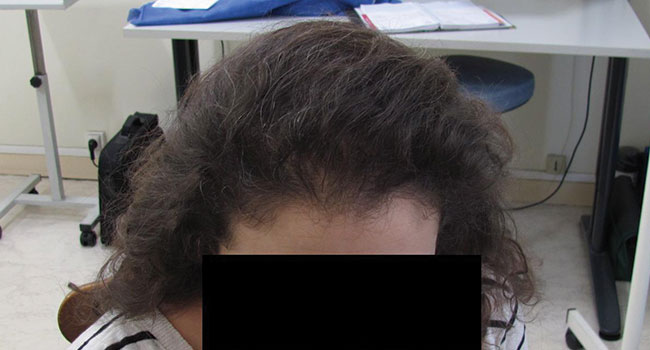 Cheveux femme après l'implantation capillaire