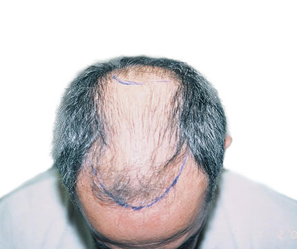 Cheveux homme avant une greffe de cheveux