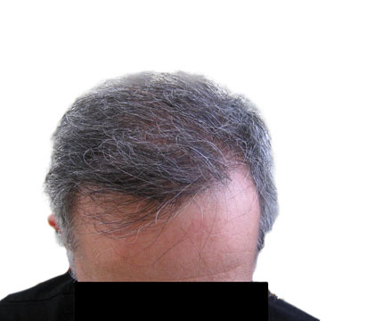 Cheveux homme après une greffe de cheveux