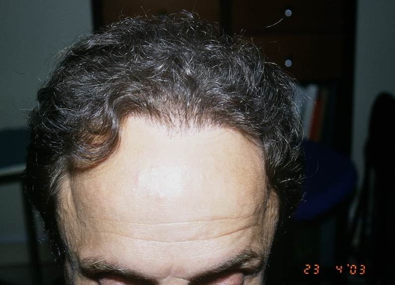 cas 10, greffe de cheveux par implantation capillaire après