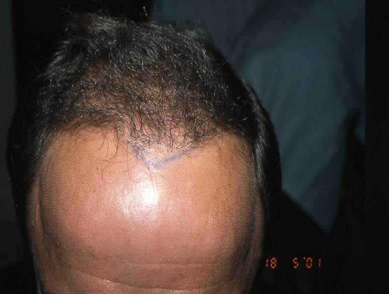 cas 10, prix dune greffe de cheveux par implantation capillaire avant