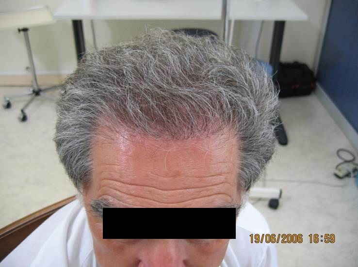 cas 11, prix dune greffe de cheveux par implantation capillaire après