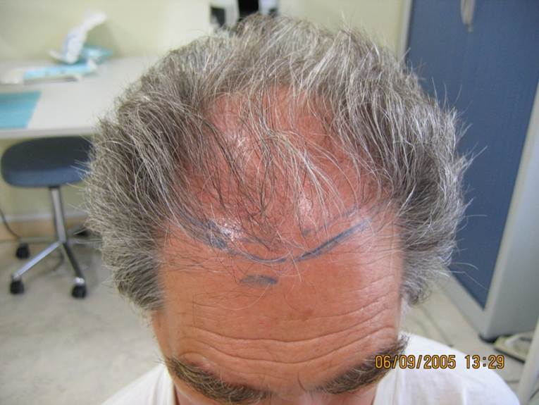 cas 11 greffe de cheveux par implantation capillaire avant