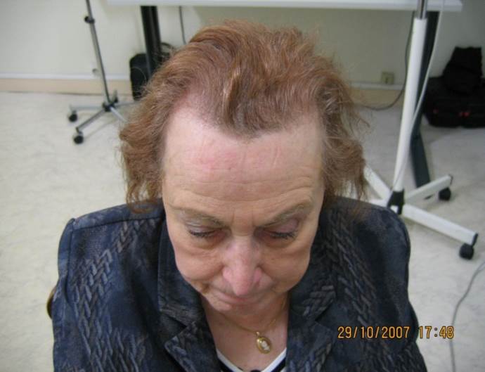 cas 12 , prix dune greffe de cheveux par implantation capillaire aprés