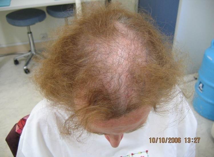 cas 12 , prix dune greffe de cheveux par implantation capillaire avant