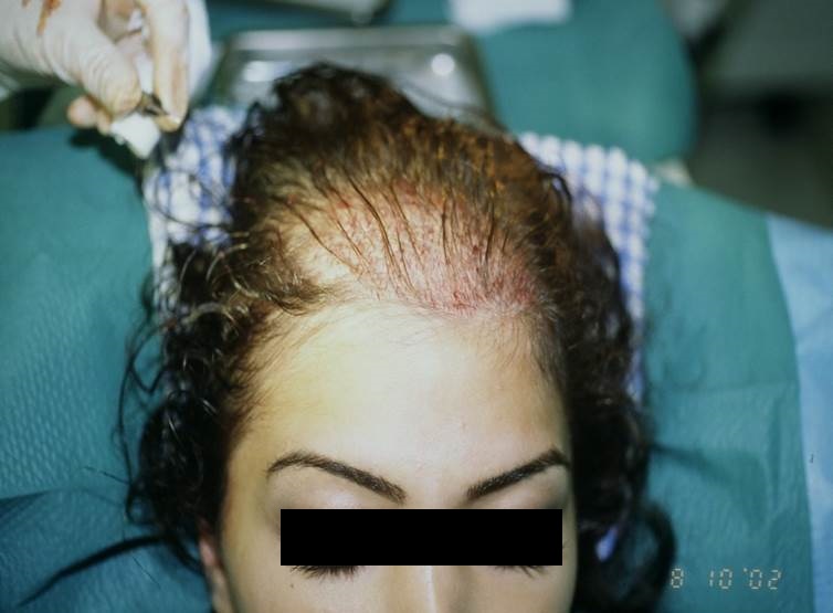 cas 14 greffe de cheveux par implantation capillaire avant