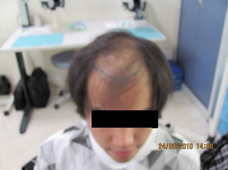 cas 2, prix dune greffe de cheveux par implantation capillaire avant