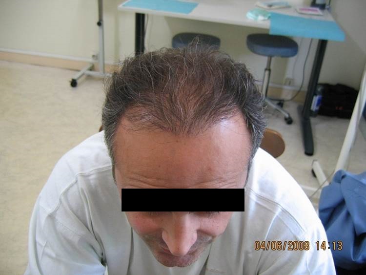 cas 3 , prix dune greffe de cheveux par implantation capillaire après