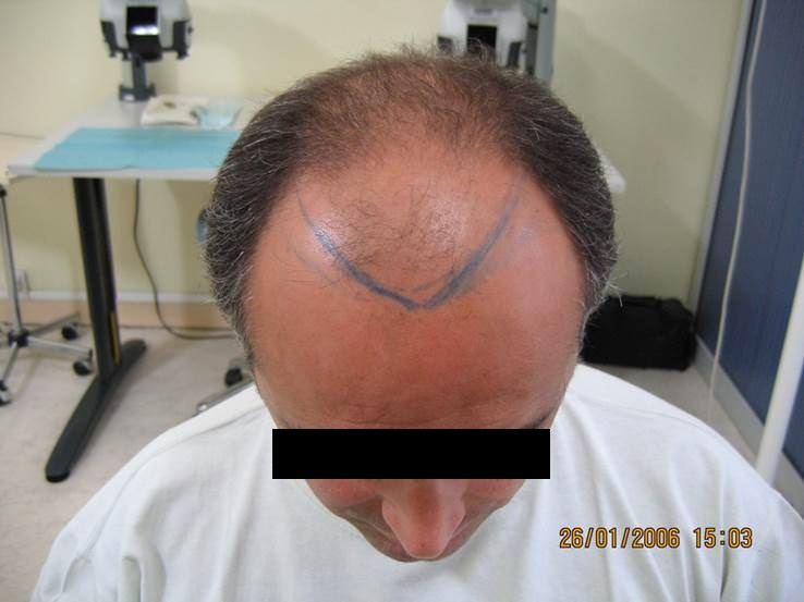 cas 3, prix dune greffe de cheveux par implantation capillaire avant