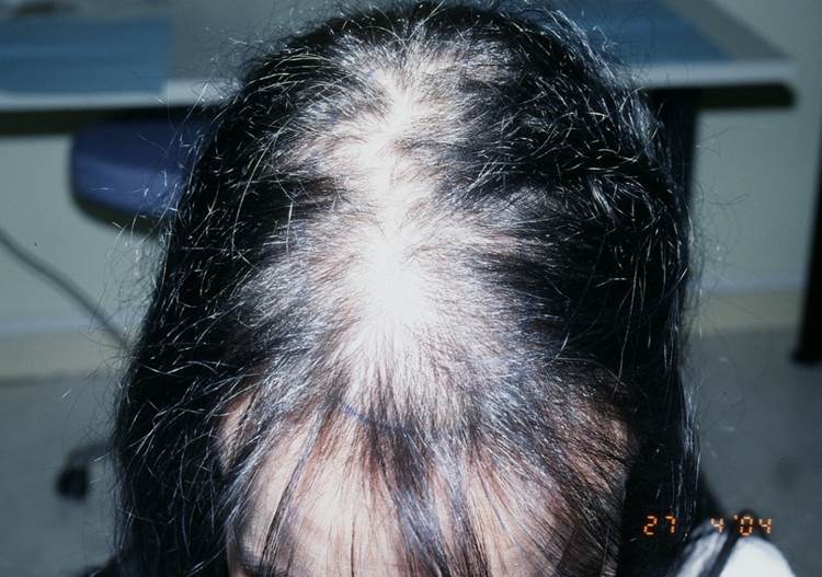 cas 5, prix dune greffe de cheveux par implantation capillaire avant