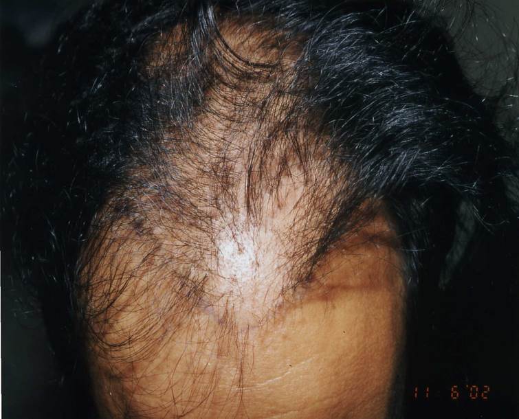 cas 7, prix dune greffe de cheveux par implantation capillaire avant