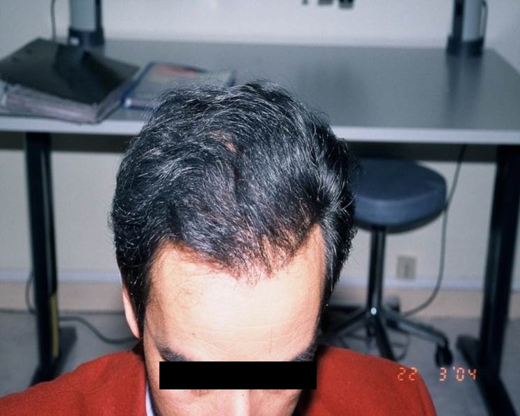cas 7 greffe de cheveux par implantation capillaire après