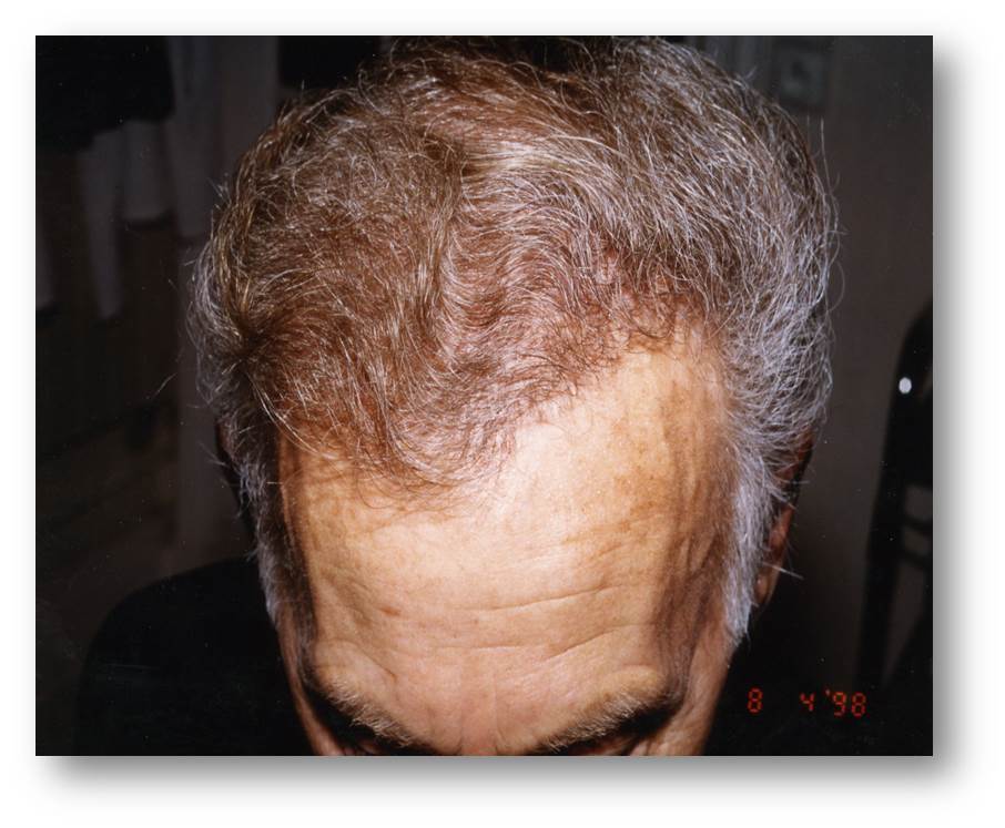 cas 8, greffe de cheveux par implantation capillaire après