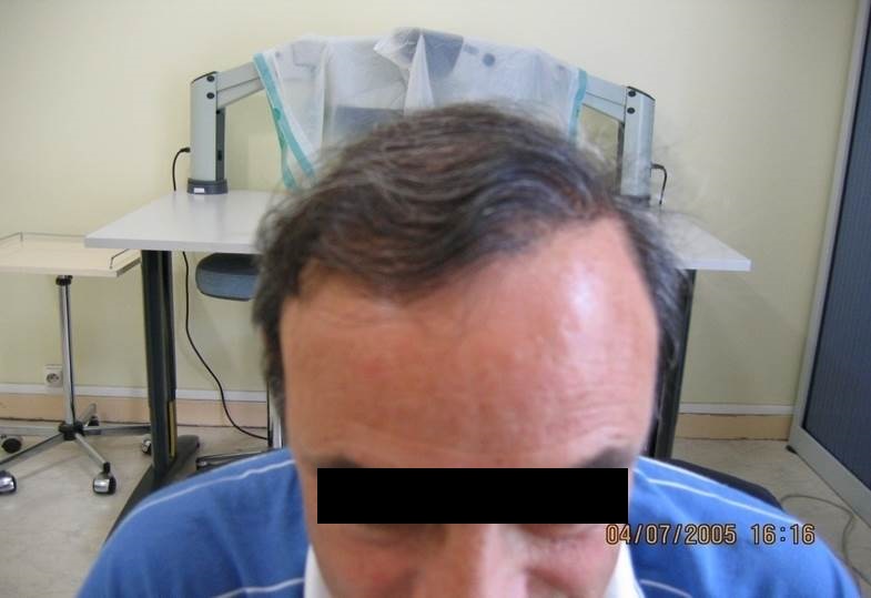 cas 9, greffe de cheveux par implantation capillaire après