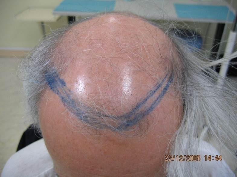 cas 1, homme de 60 ans avant une greffe de cheveux