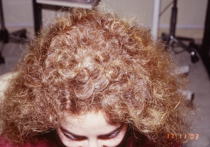 cas 1 greffe de cheveux par implantation capillaire après