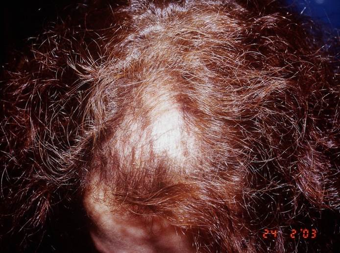 cas 1 greffe de cheveux par implantation capillaire chez une femmme avant