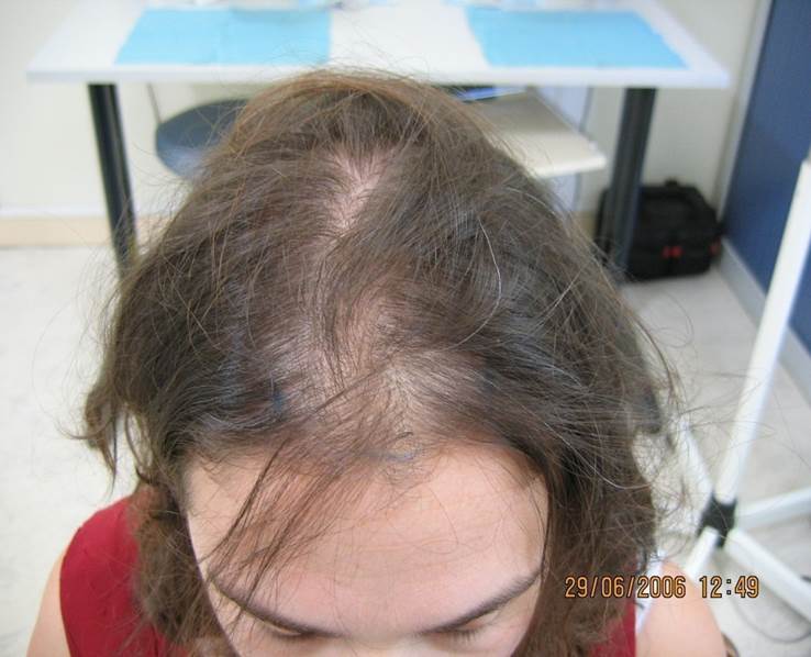 cas 10 avant greffe cheveux femme implant capillaire prix