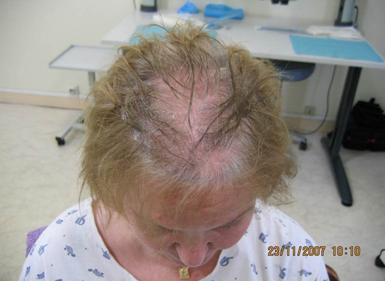 cas 12 avant greffe cheveux femme implant capillaire prix