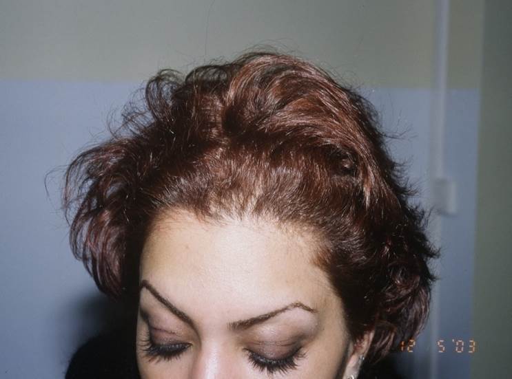 cas 2 apès greffe cheveux femme implant capillaire prix