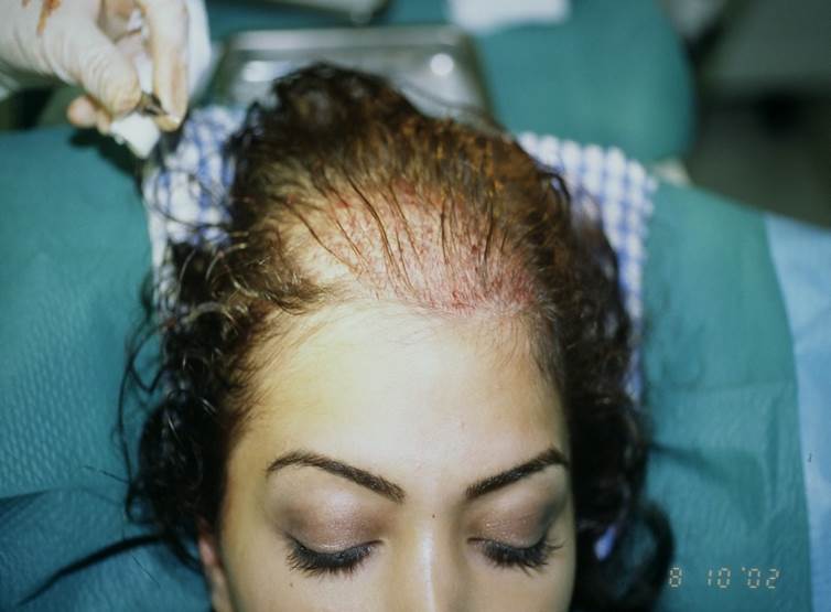 cas 2 avant greffe cheveux femme implant capillaire prix