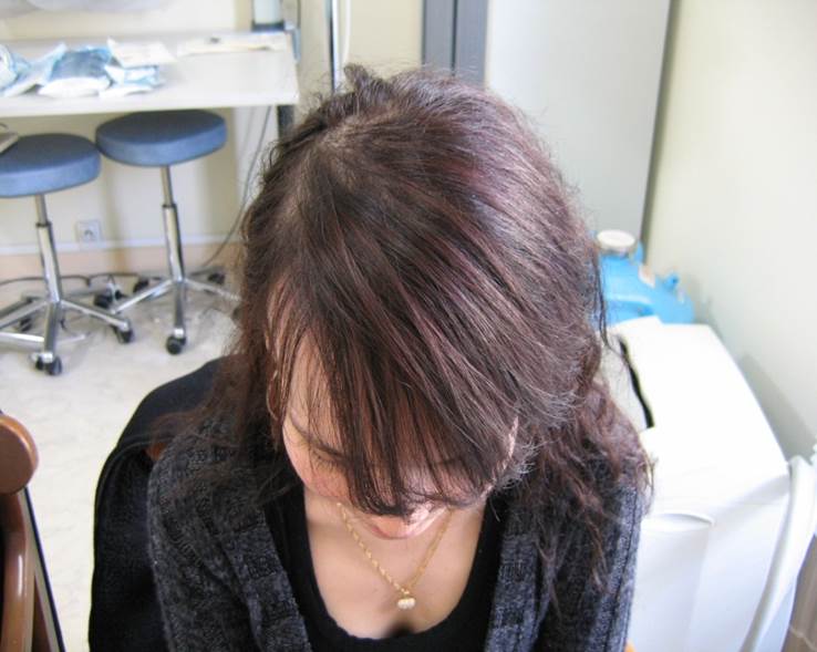 cas 2, prix dune greffe de cheveux par implantation capillaire après chez une femmme