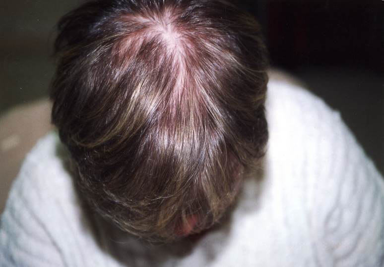 cas 3 après greffe cheveux femme implant capillaire prix