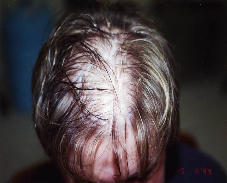 cas 3 avant greffe cheveux femme implant capillaire prix