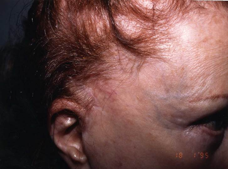 cas 4 avant greffe cheveux femme implant capillaire prix