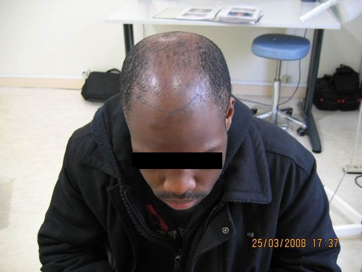 cas 4, jeune homme de 25 cheveux crépus avant la greffe de cheveux