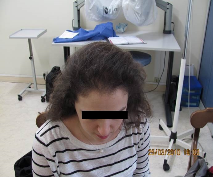 cas 4 greffe de cheveux par implantation capillaire aprés chez une femmme