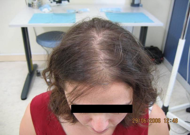 cas 4, prix dune greffe de cheveux par implantation capillaire avant chez une femmme