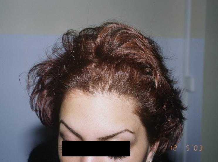 cas 5, prix dune greffe de cheveux par implantation capillaire aprés chez une femmme