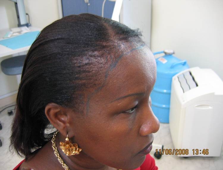 cas 6 avant greffe cheveux femme implant