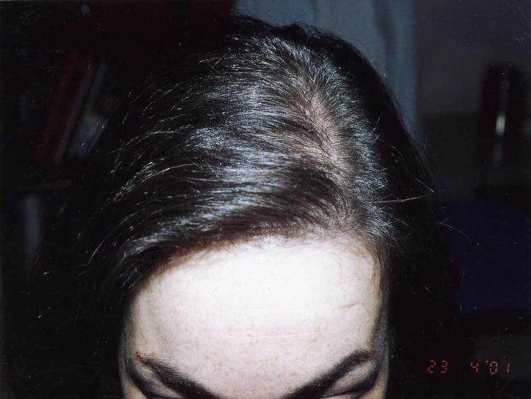 cas 7 après greffe cheveux femme implant capillaire prix