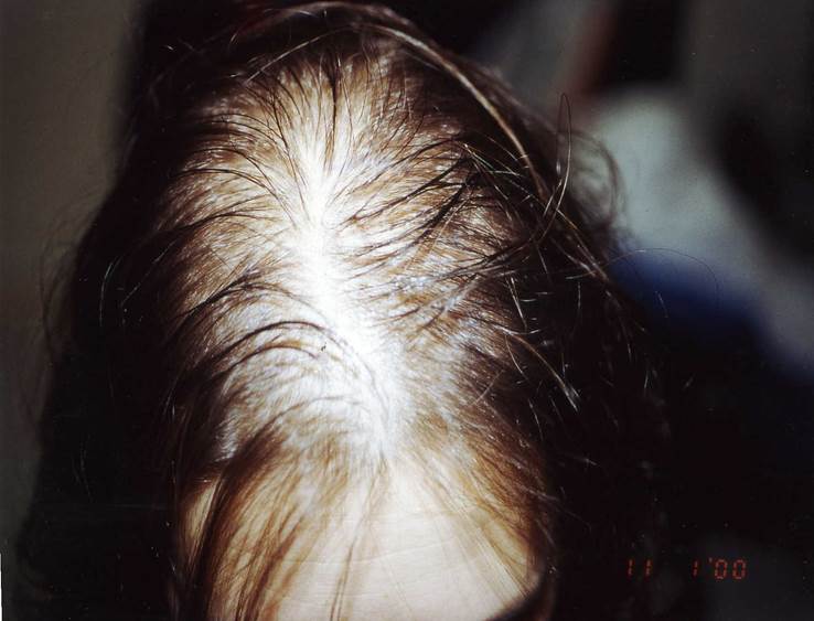 cas 7 avant greffe cheveux femme implant capillaire prix
