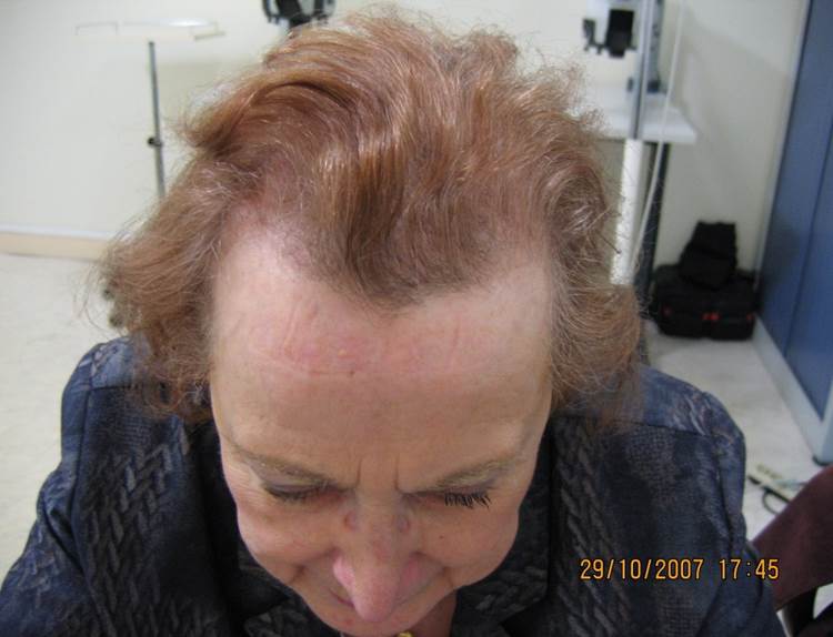 cas 9 après greffe cheveux femme