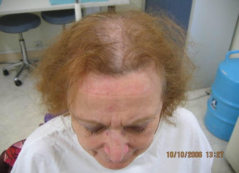 cas 9 avant greffe cheveux femme